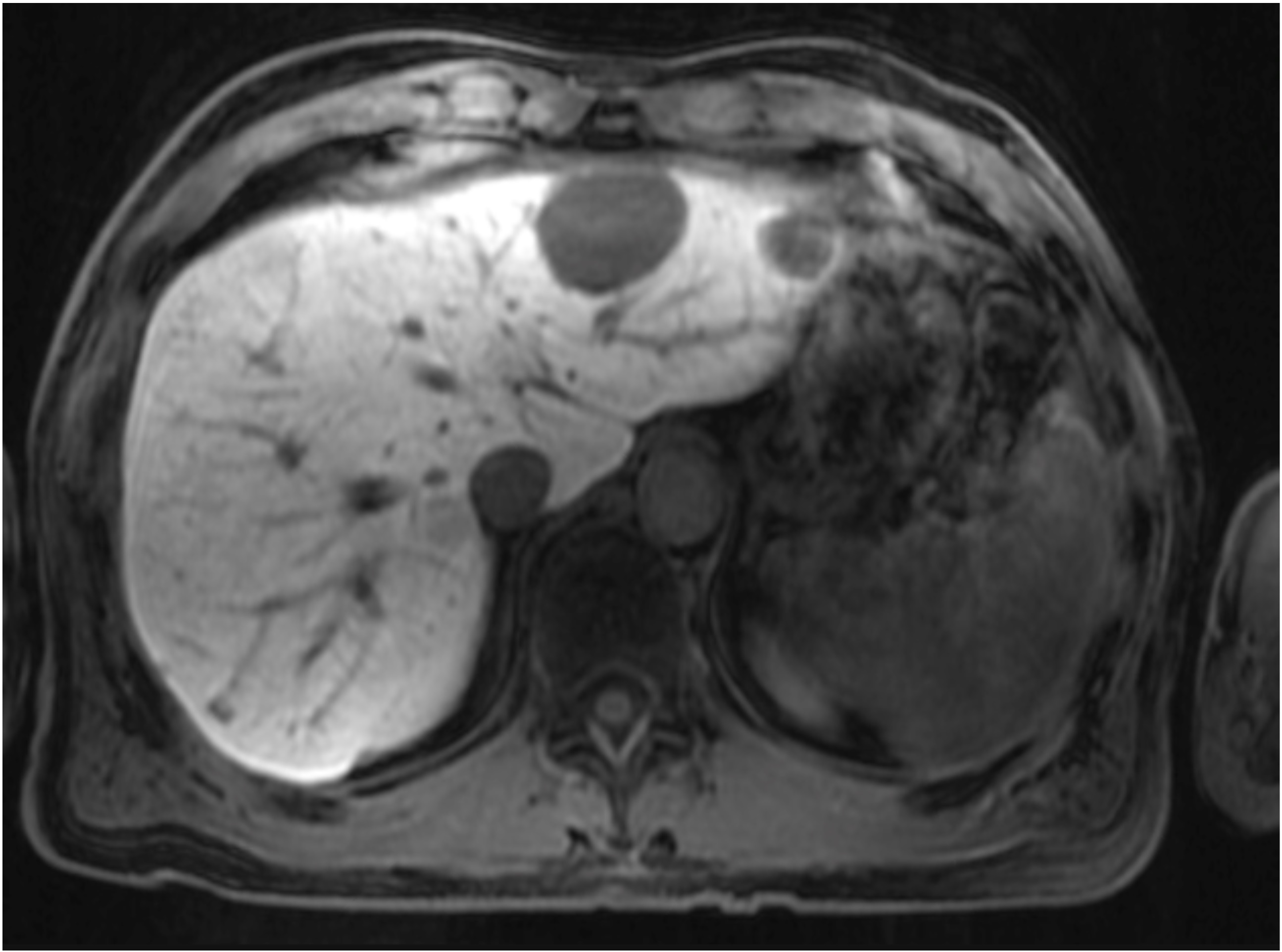 White Spots On Liver Mri